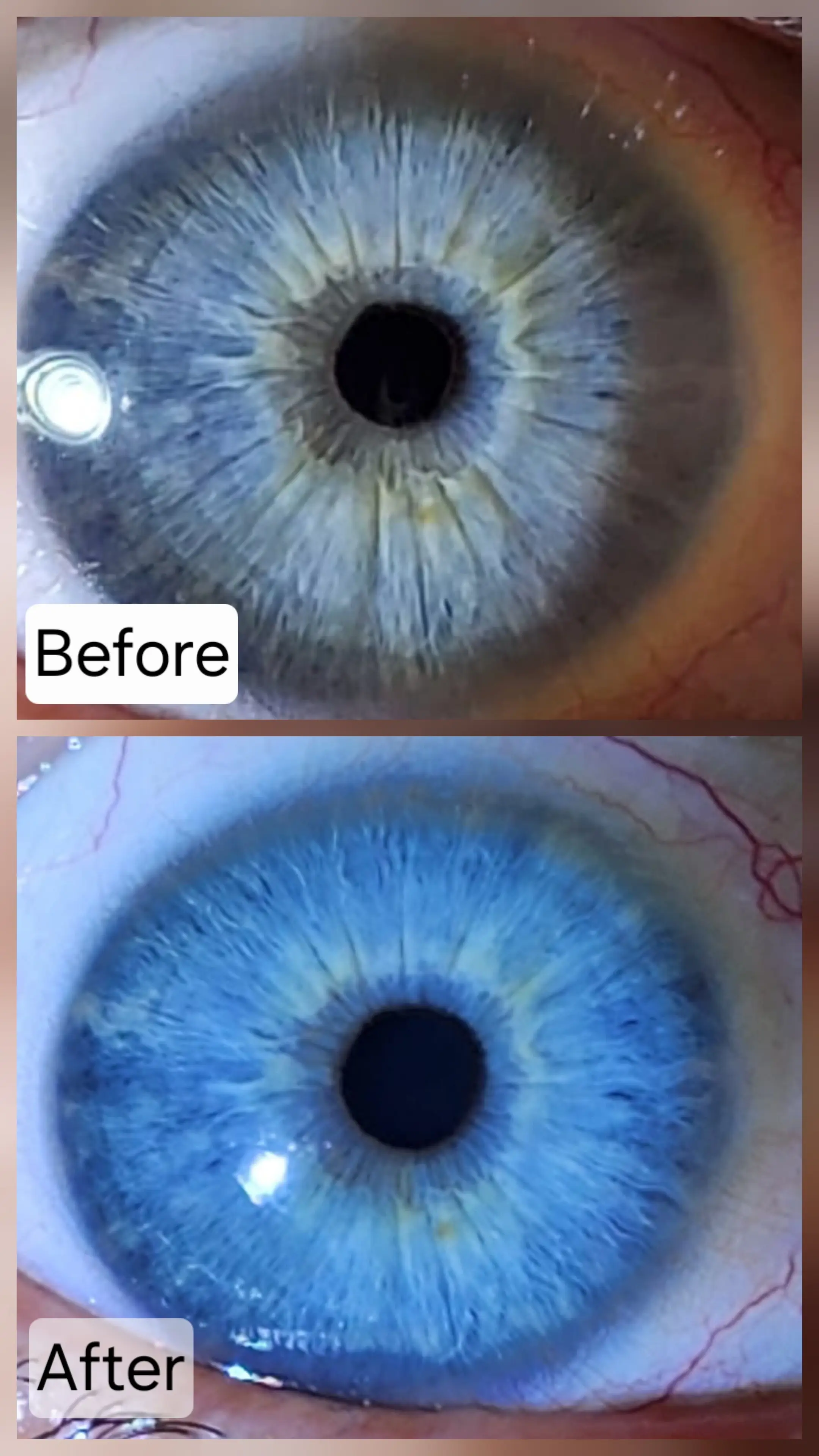 Iris analysis showing changes before and after natural detox program