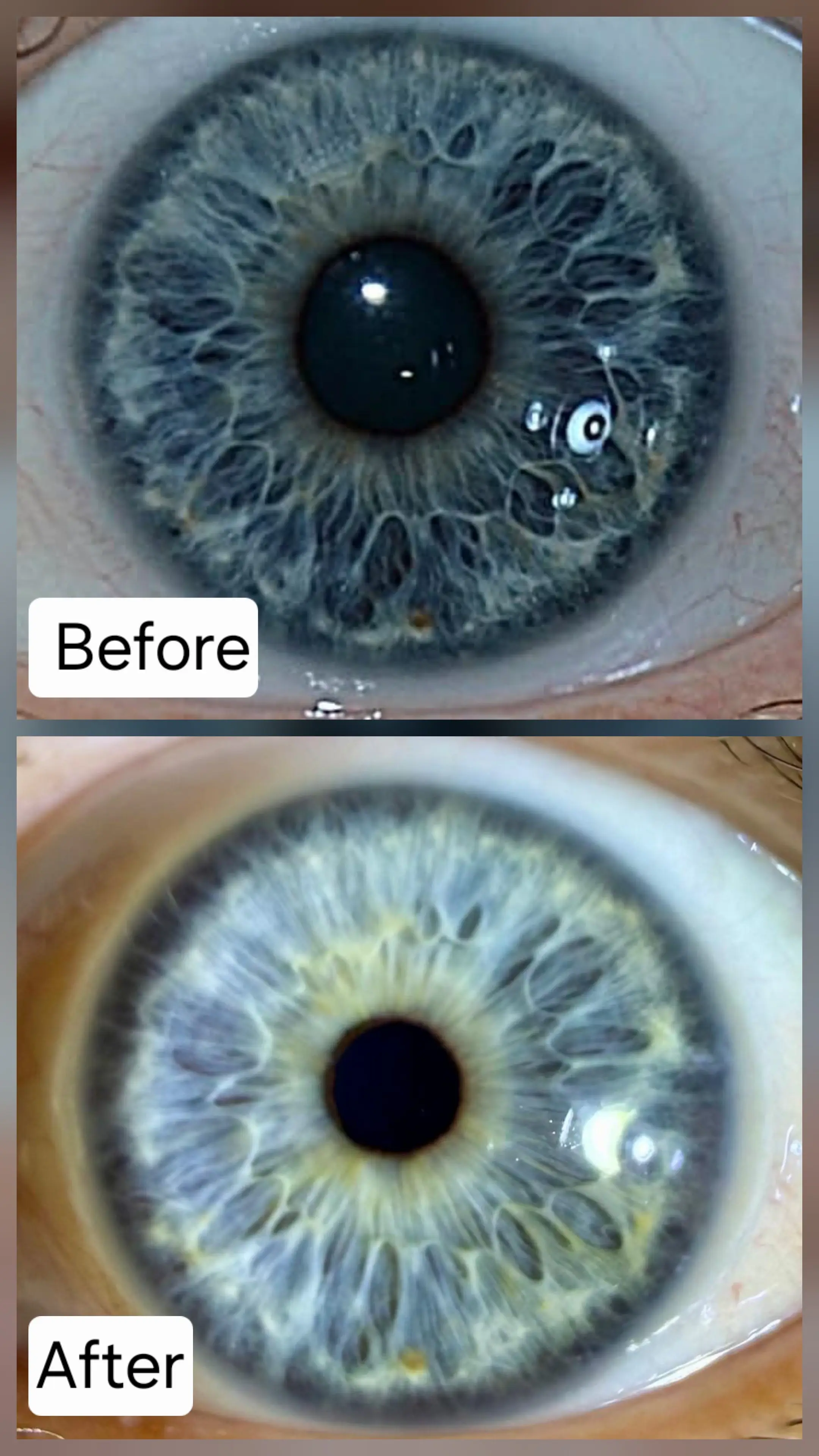 Iridology reading tracking reduction in chronic inflammation signs