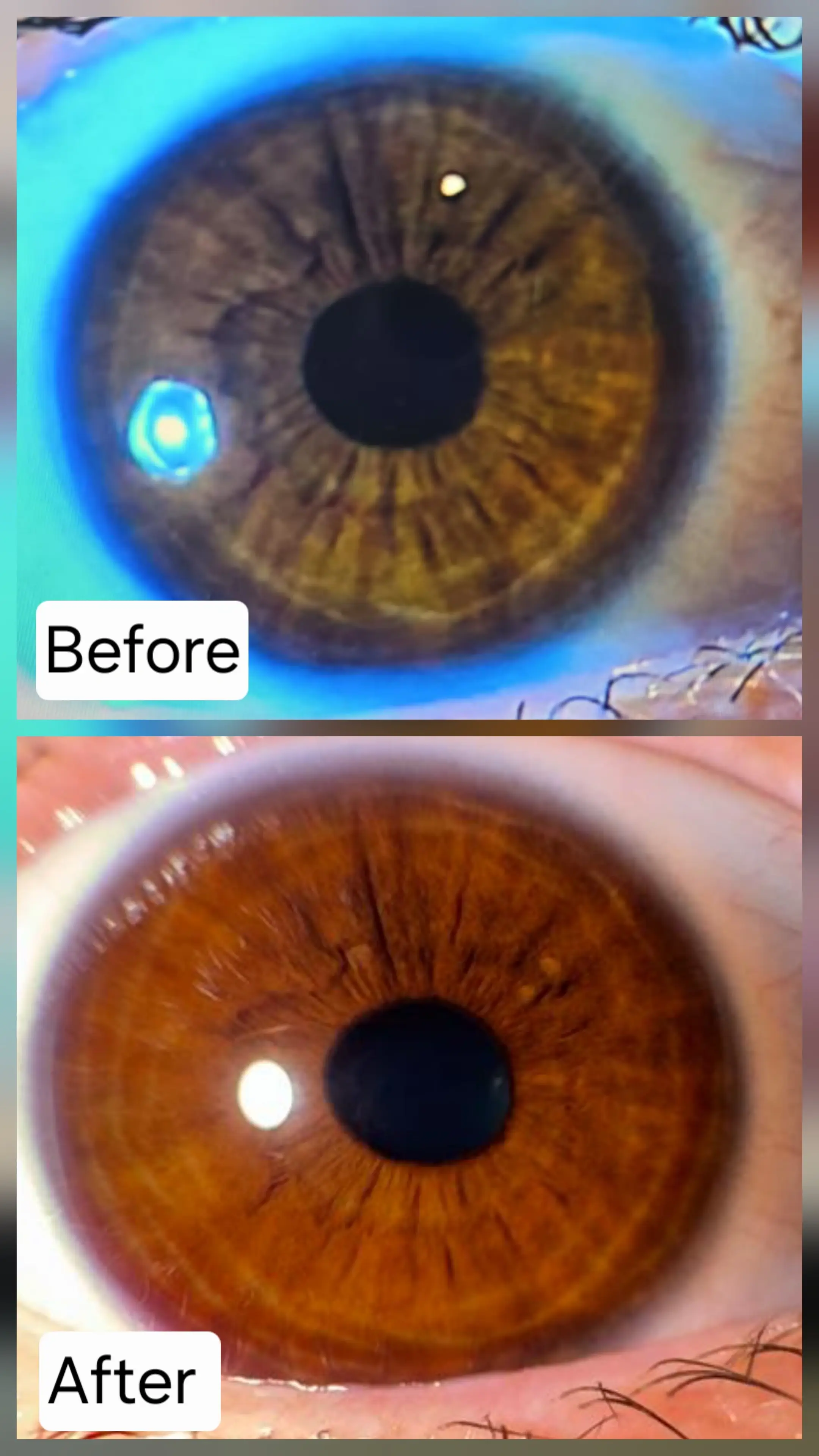Visual iris improvements from a parasite cleanse and lymphatic detox