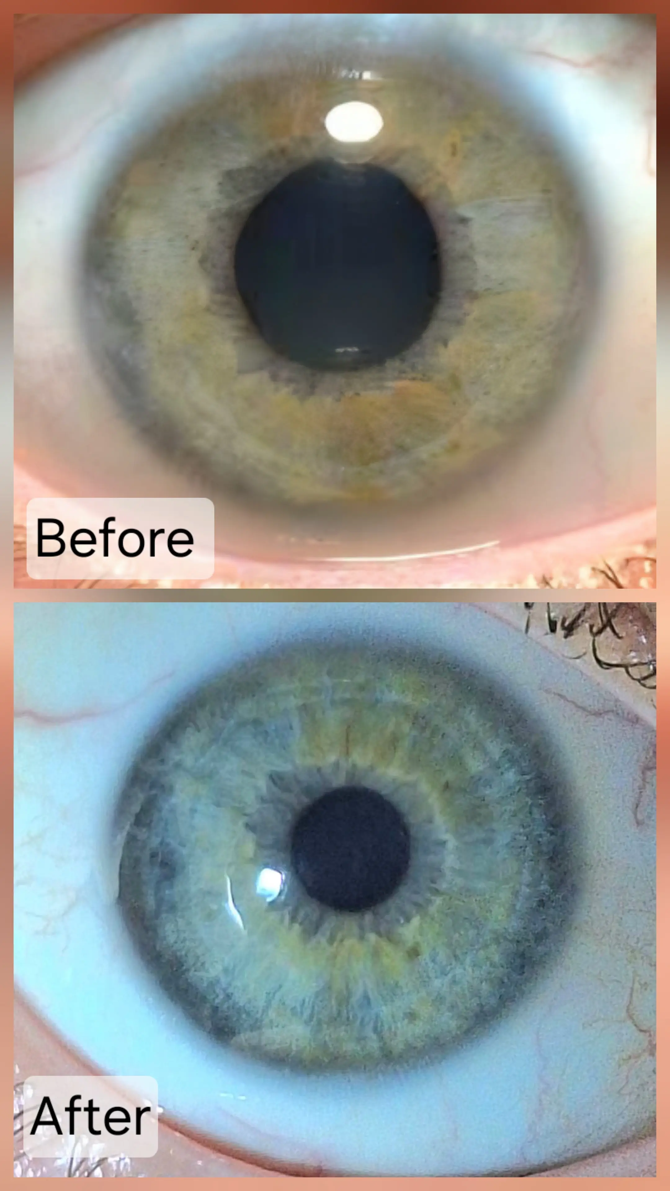 Before and after iris reading showcasing skin health and acne recovery