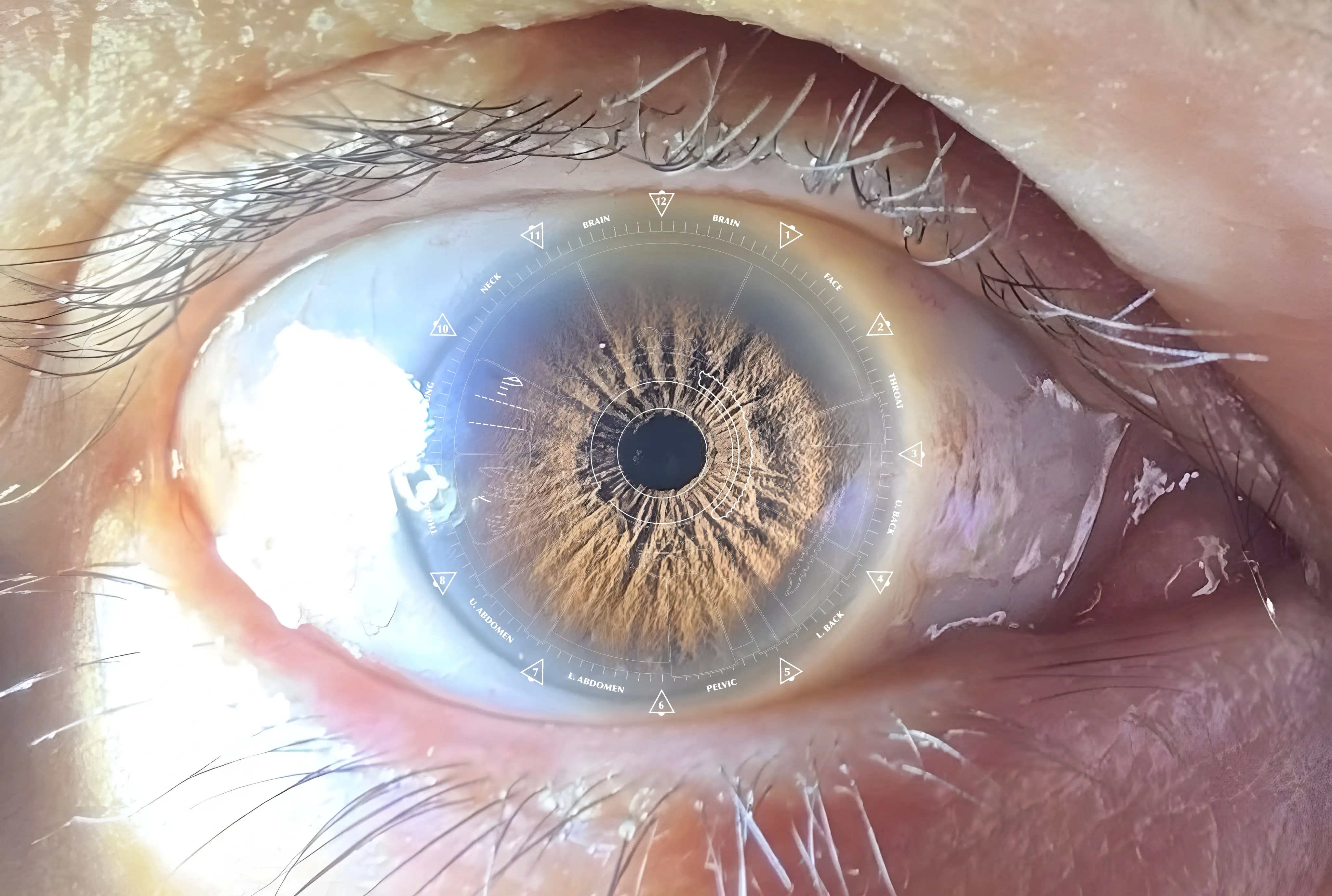 Iris analysis showing gut wall weakness, leaky gut, and digestive issues