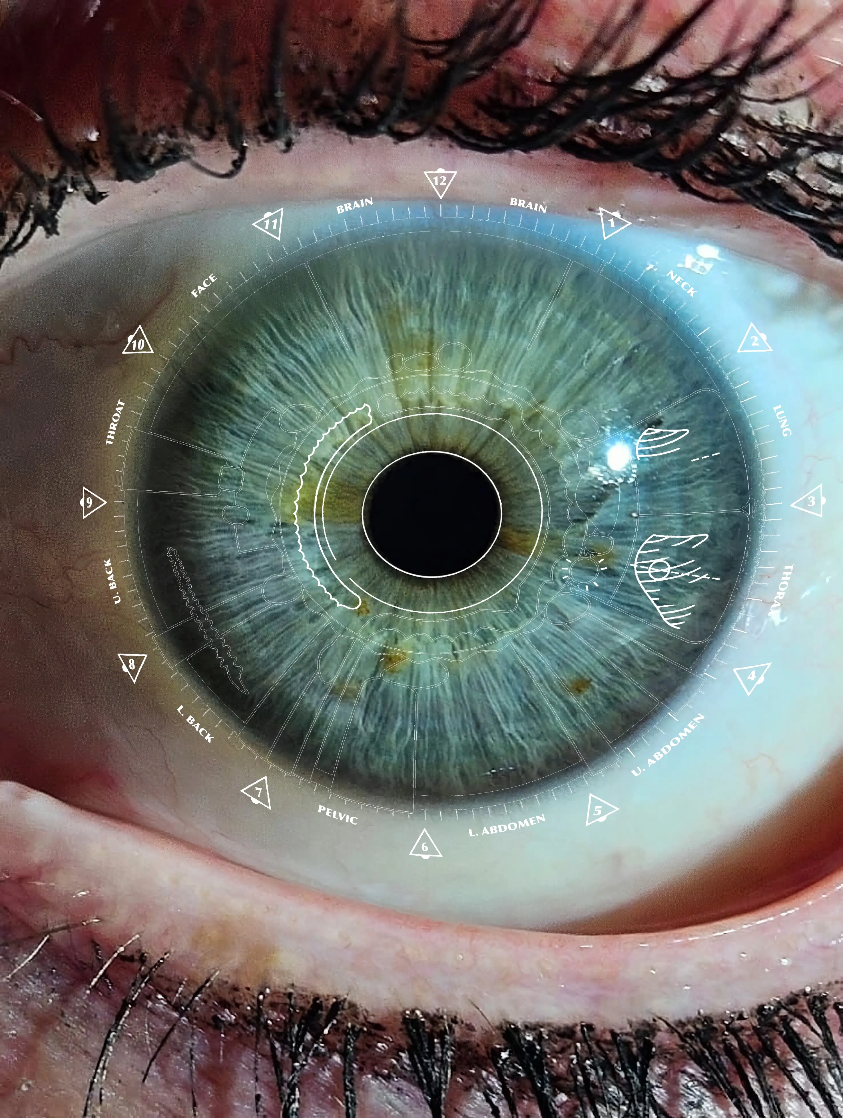 Iris reading showing systemic lymphatic congestion and chronic inflammation signs