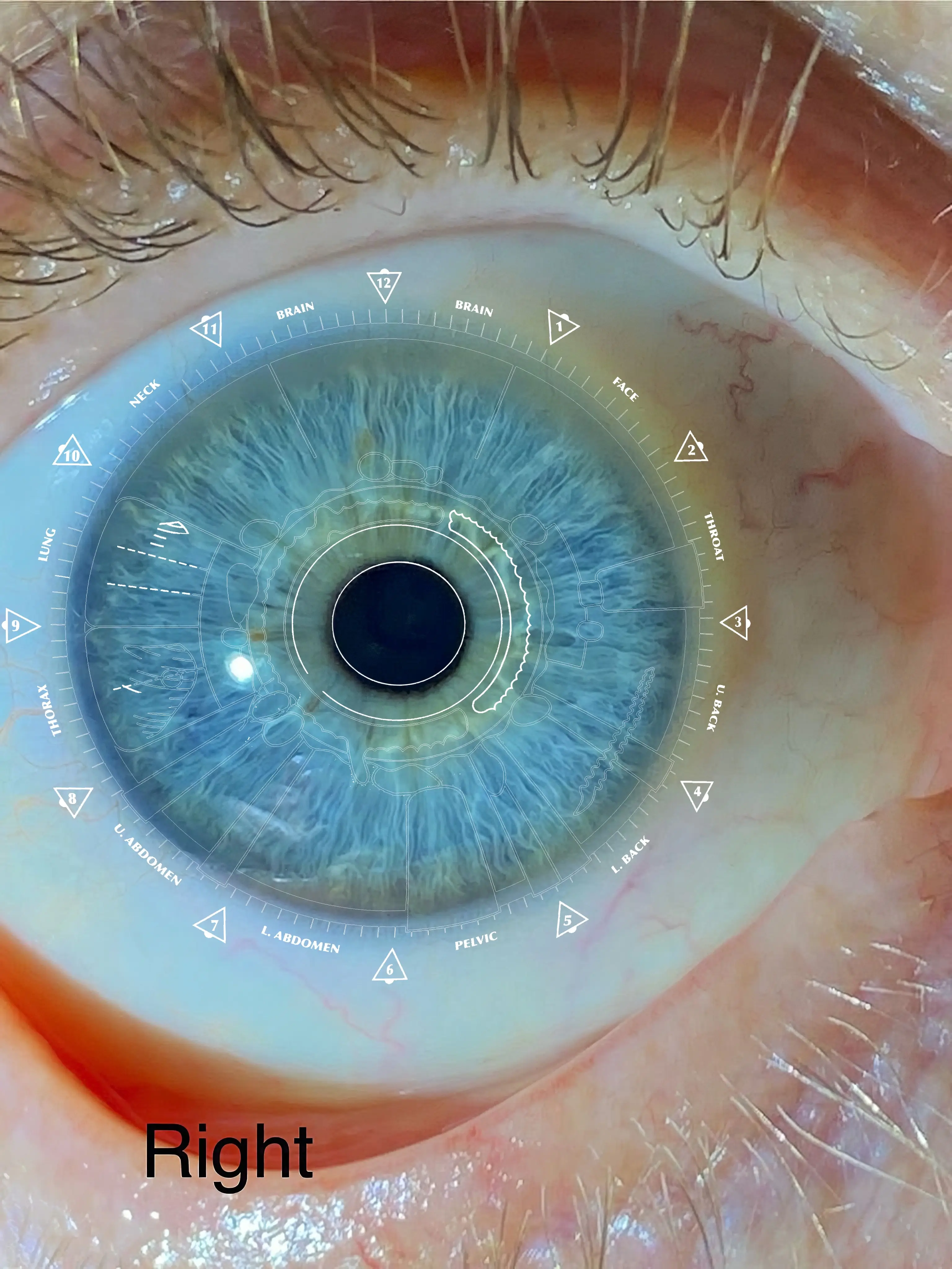 Iridology assessment for digestive congestion, candida, and bloating