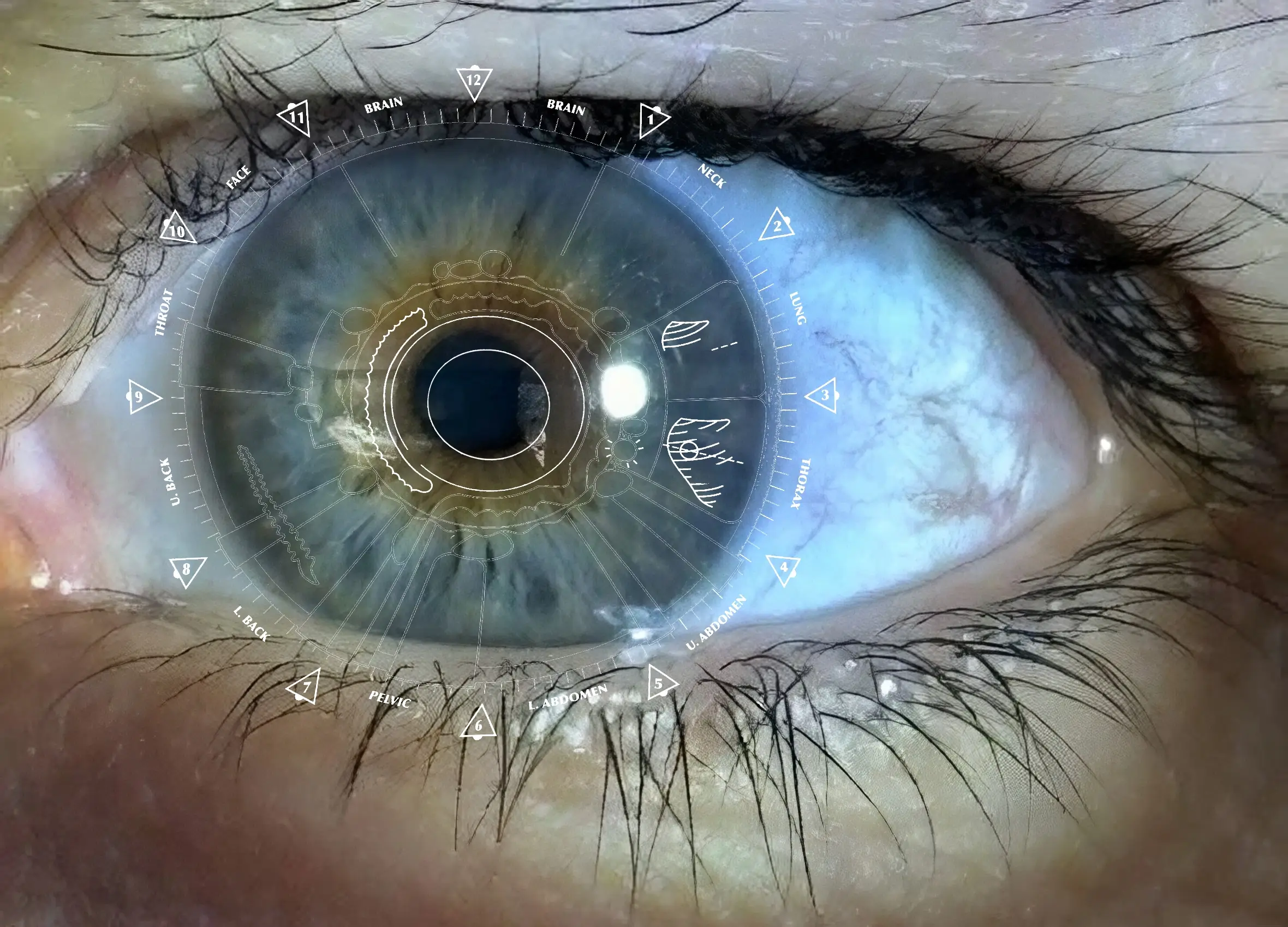 Iris analysis showing scurf rim and skin elimination issues related to eczema and acne