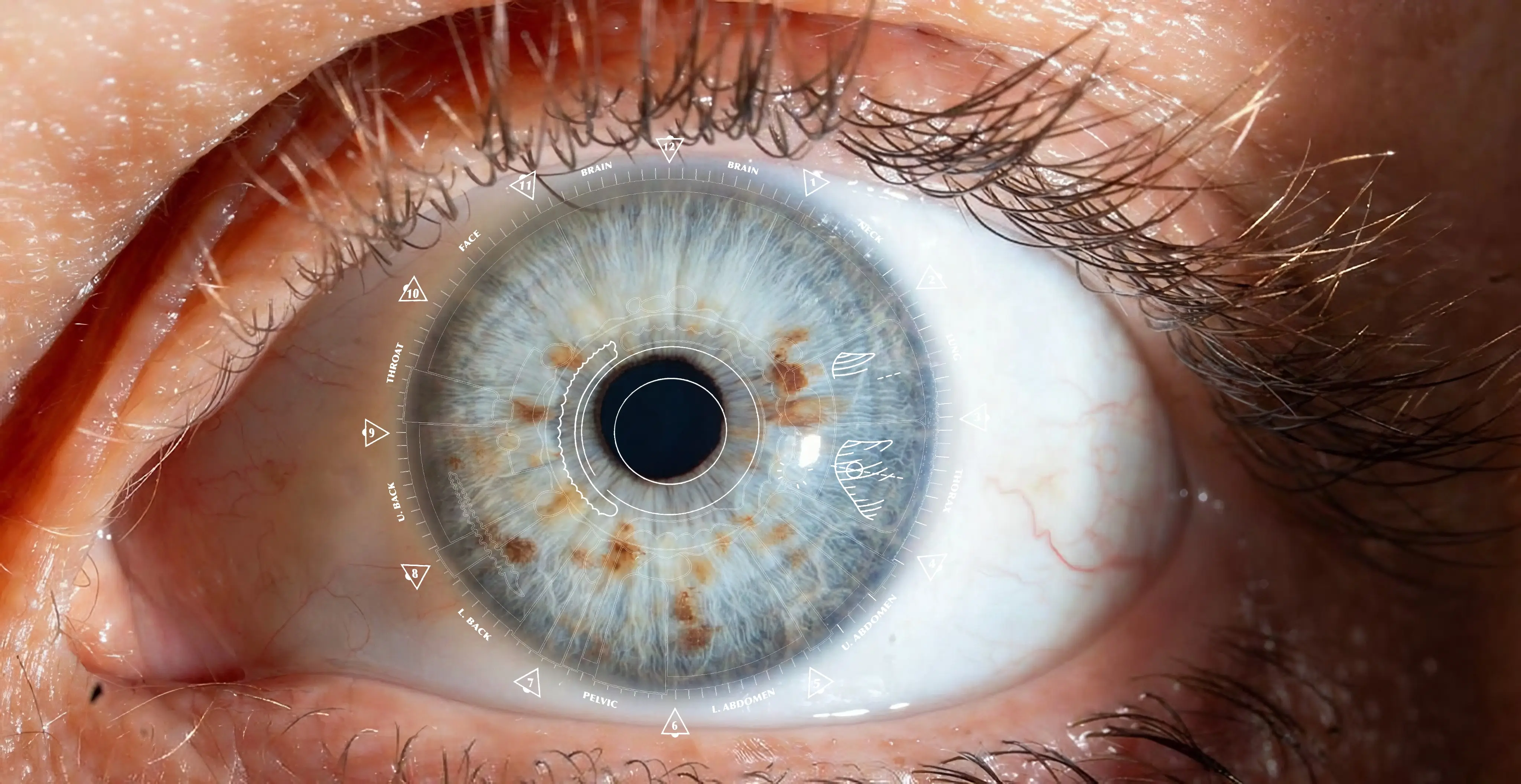 Iridology overlay showing lymphatic system congestion and chronic inflammation signs