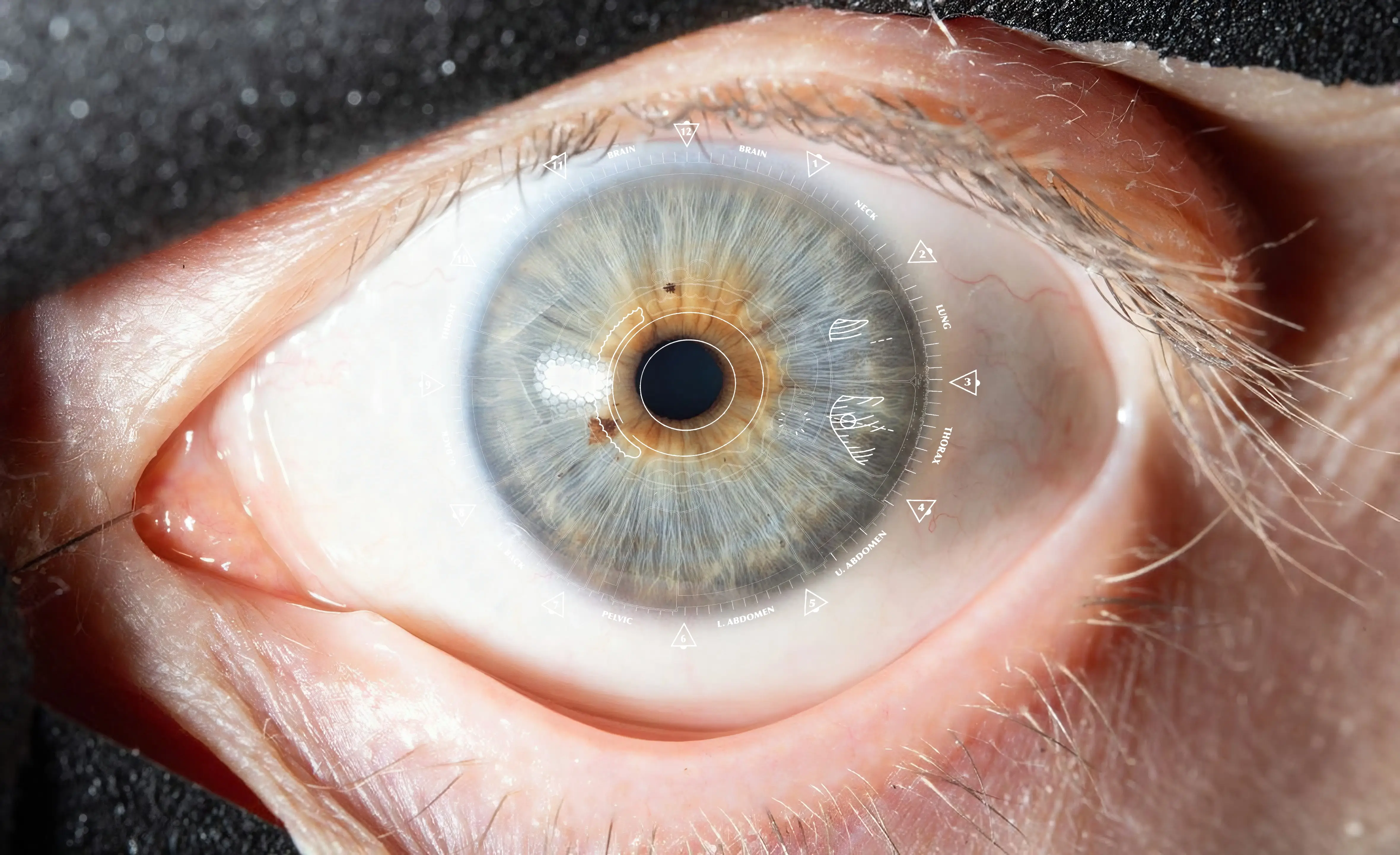 Iris markings indicating genetic weaknesses and heavy metal detox priority